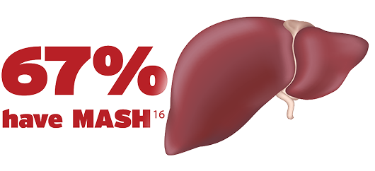 Risk of MASH in US adults with sHTG, up to 67% have MASH