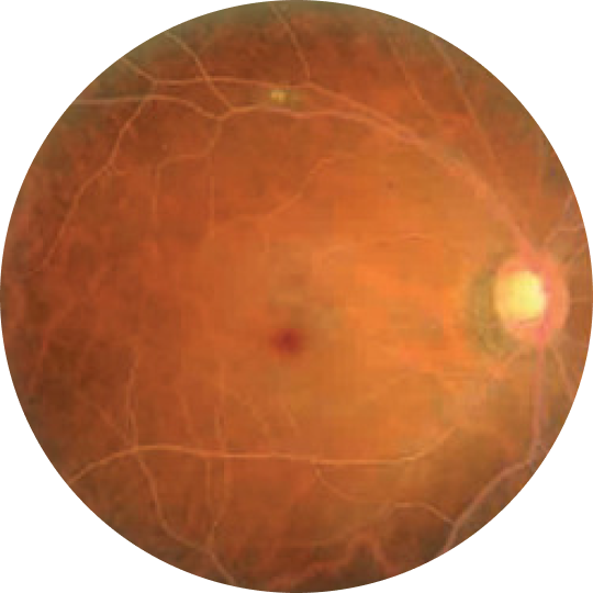 Lipemia Retinalis picture of lipemia retinalis