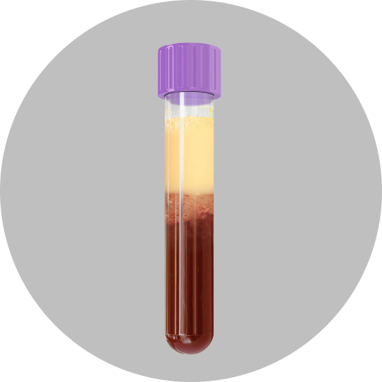 Lipemic Blood picture of a vial of lipemic blood