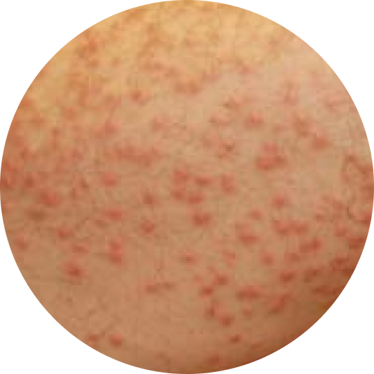 picture of eruptive xanthomas