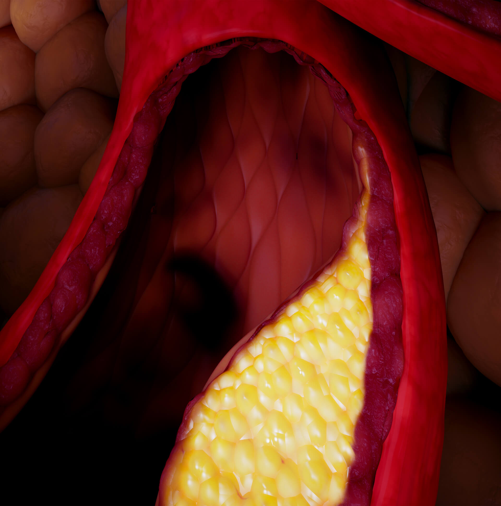 Atherosclerotic Lesion