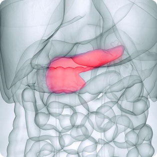 Acute Pancreatitis X-Ray Image