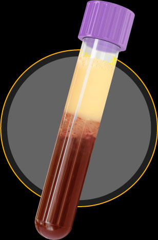 Blood of FCS patient showing creamy/milky appearance